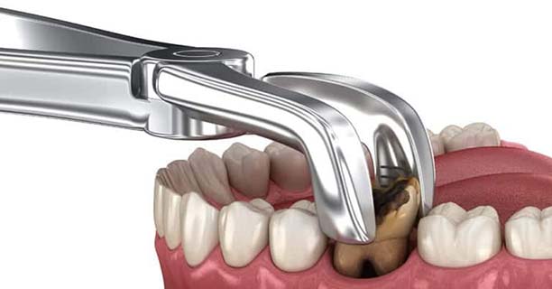 Tooth Extractions